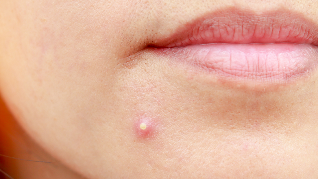 How to prevent acne?